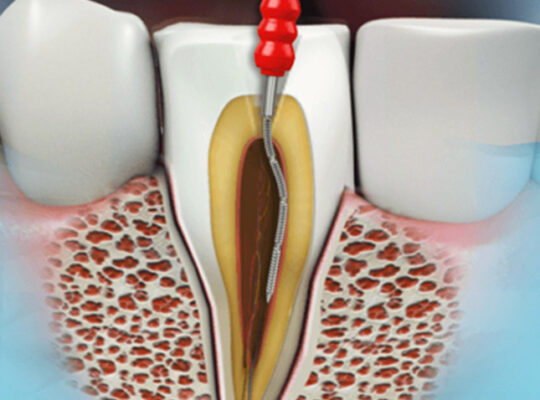 Dental Implants in Delhi