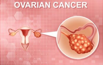Top-rated Surgeons for Ovarian Cancer Surgery in A