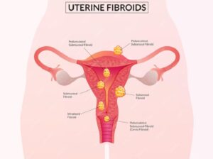 Best Doctors for Uterine Fibroids Treatment in Ahm