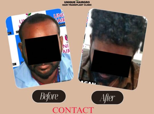 Best Hair Transplant Clinic In Tamilnadu