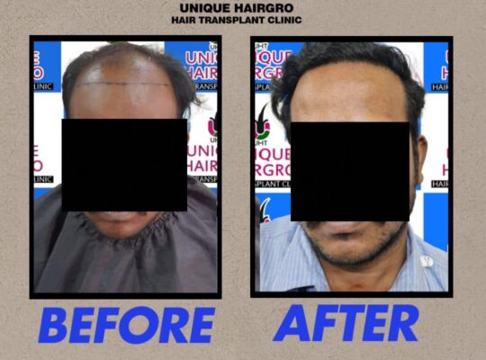 Best Hair Transplant Clinic In Tamilnadu