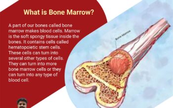 Bone marrow transplant in Hyderabad—Dr. SK Gupta