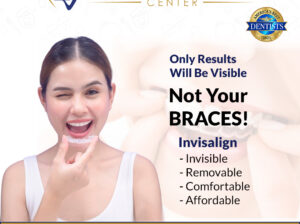 Clear Aligners in Dallas