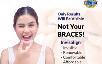 Clear Aligners in Dallas