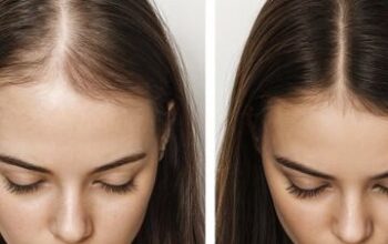 Transform Your Hair Naturally at Noida’s Most Trusted Hair Clinic